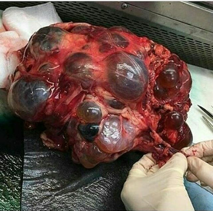 Polycystic kidney disease.  
