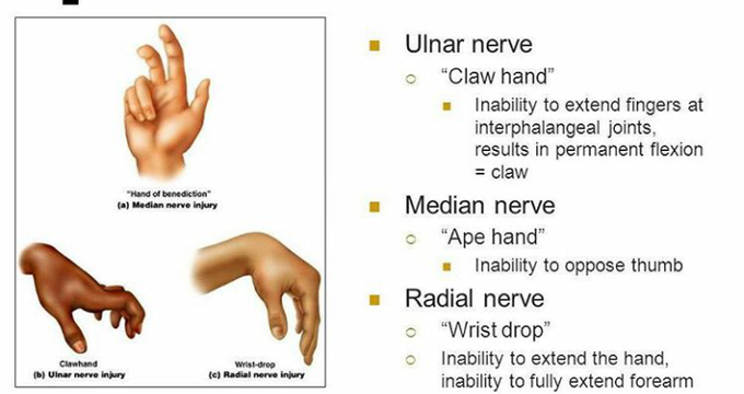 Nerve Damage
