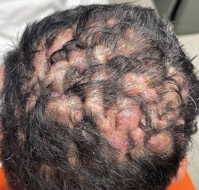 Dissecting Cellulitis of the Scalp
