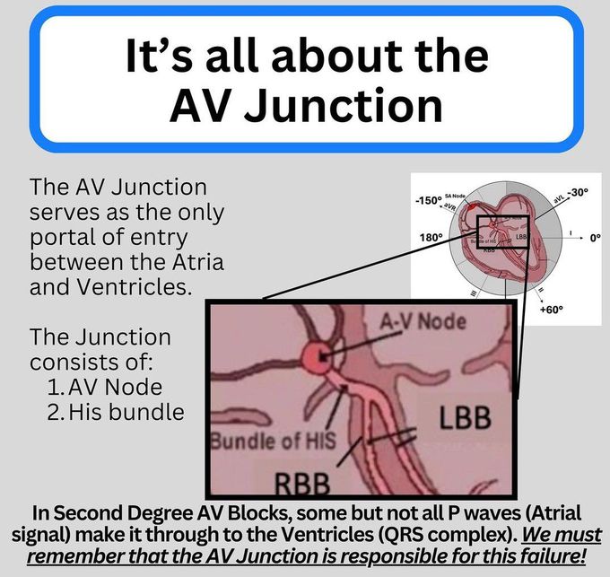 AV Junction