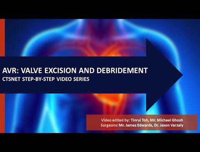CTSNet Step-by-Step Series: AVR Valve Excision and Debridement