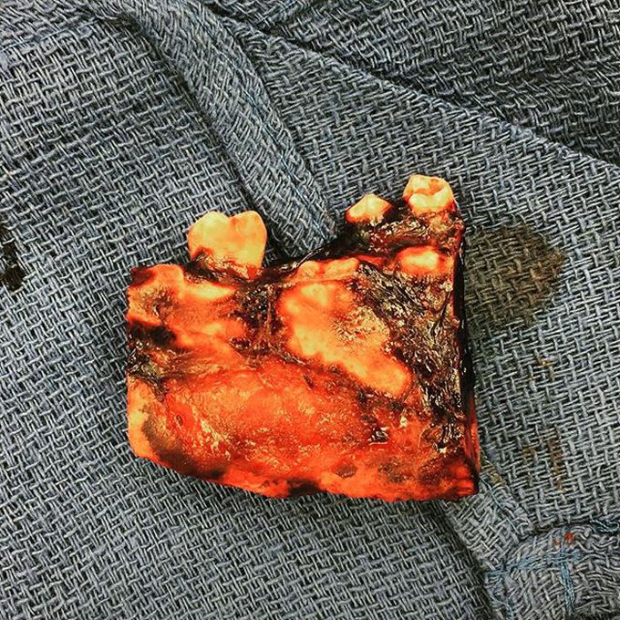 Partial resection of the mandible due to osteomyelitis Part I 👨‍⚕️🙌 • 