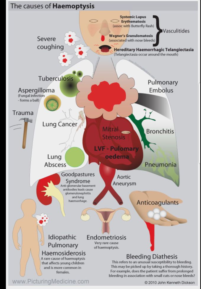 Causes of Heamoptysis