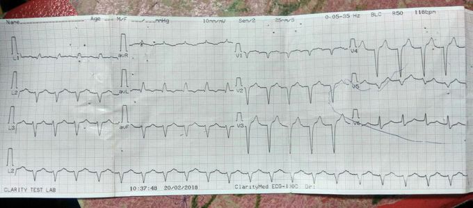 Electrocardiogram
