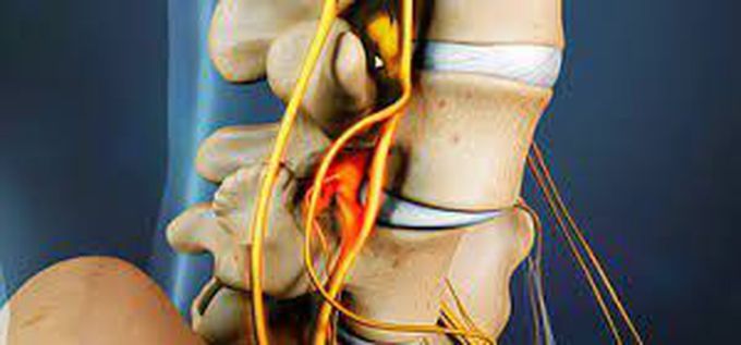 Causes of spondylosis