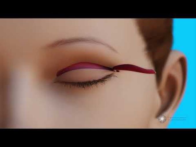 Blepharoplasty-Animation