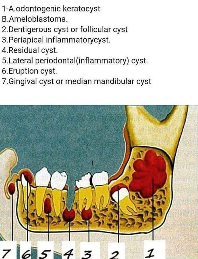 Location of cyst and tumour!!!