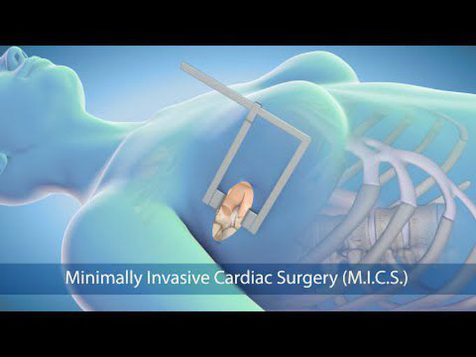 Minimal invasive cardiac surgery