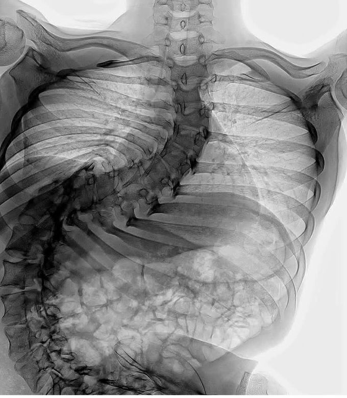 Scoliosis