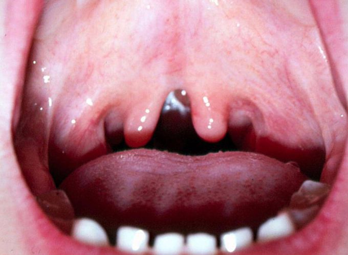 Middle split of tongue in Causes and