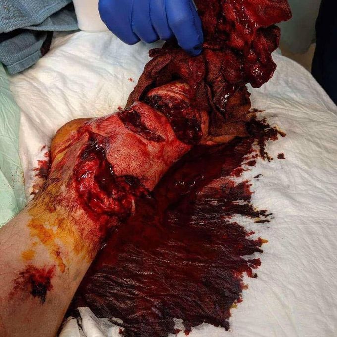Foot lacerations caused by a lawnmower! 
