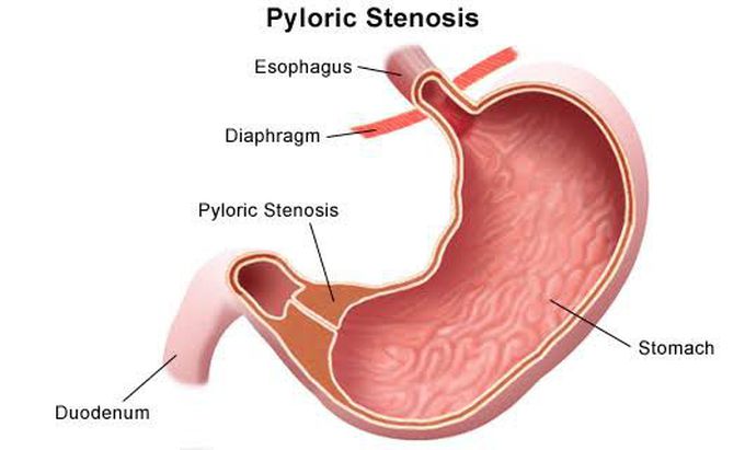 Hypertrophic Pyloric Stenosis