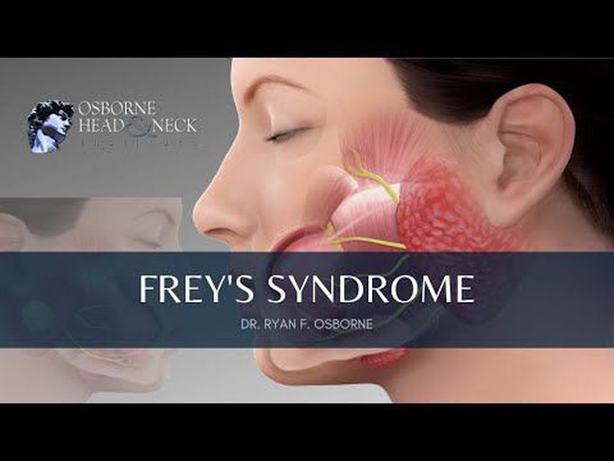 Parotid Glang: Frey’s Syndrome