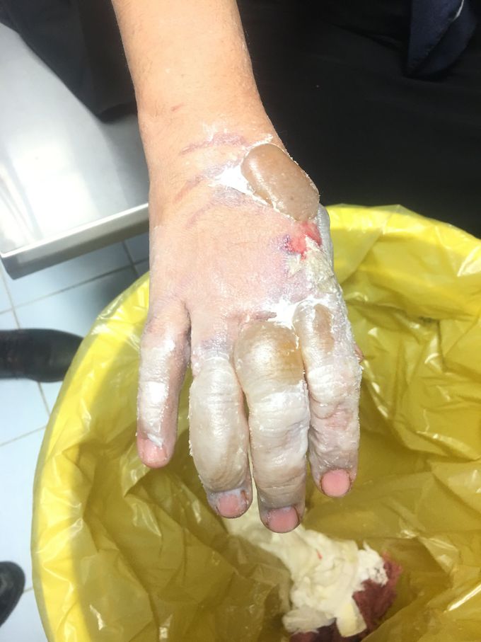 Burned hand