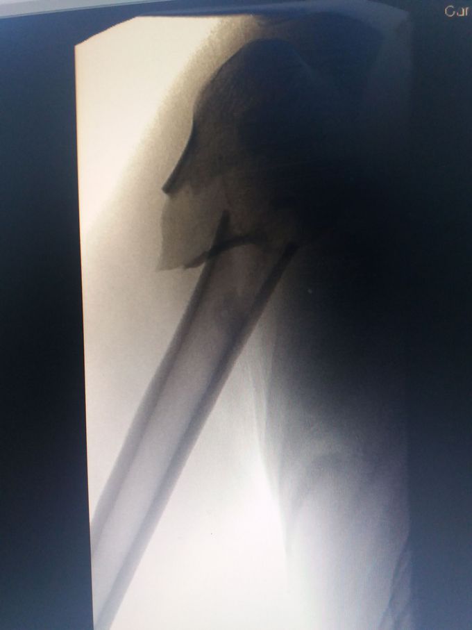 Fracture on the X ray