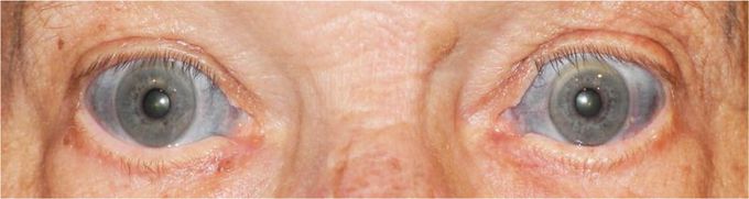 Scleral Discoloration from Minocycline Treatment