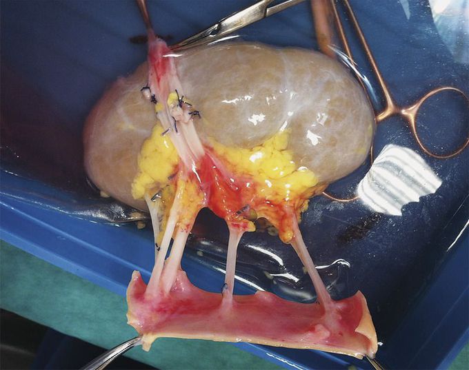 Multiple Renal Arteries