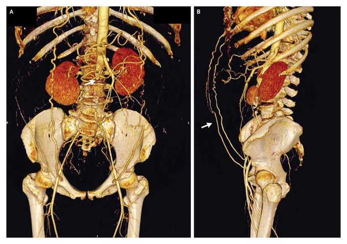 Infrarenal Aortic Occlusion