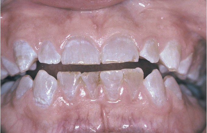 Dentinogenesis Imperfecta (DGI).