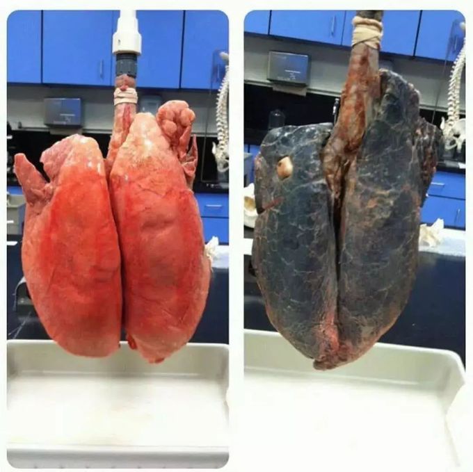 Healthy Vs smokers lung