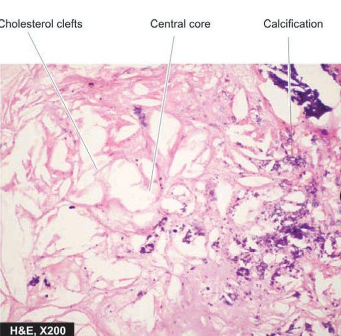 Atheromatous plaque
