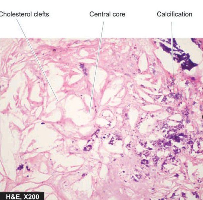 Atheromatous plaque