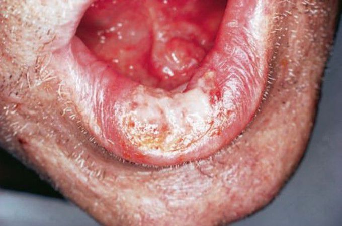 Histoplasmosis of lip