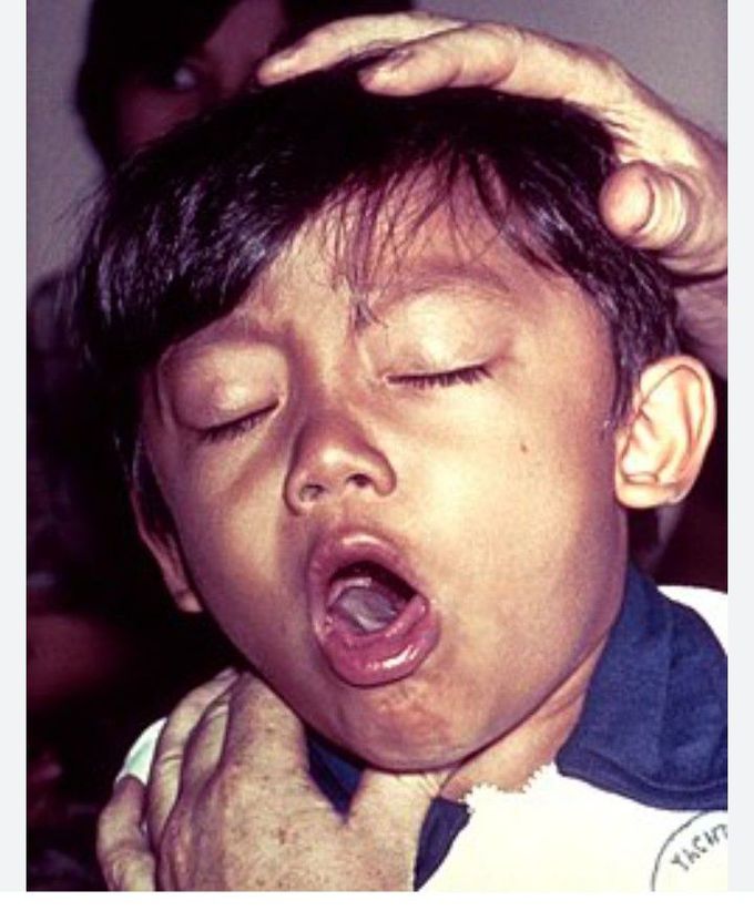 Whooping Cough