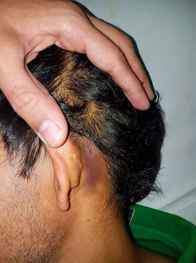 Battle's Sign (Basal Skull Fracture)