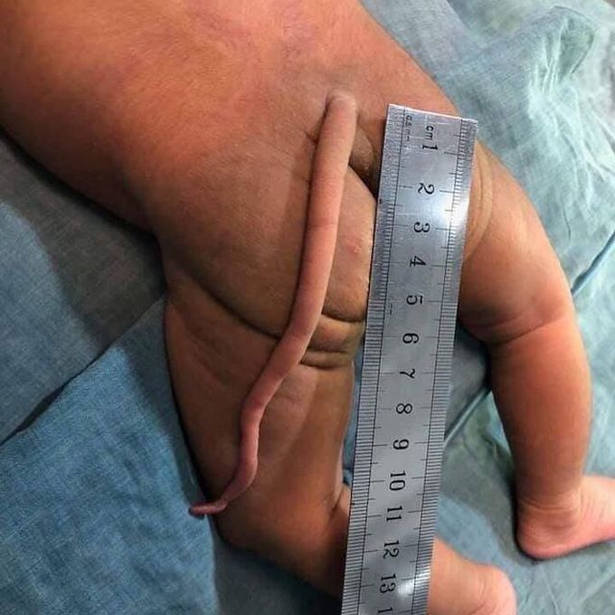 Case of a baby born with a tail (vestigial tail)!!!