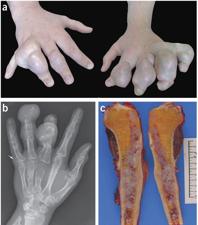 Ollier's Disease