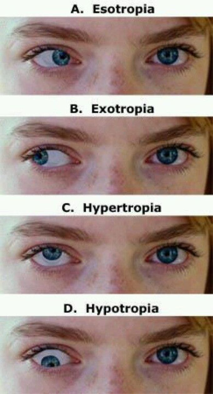 Операция на косоглазие цена. Косоглазие. Вертикальное косоглазие. Косоглазие у взрослых. Экзотропия глаза.