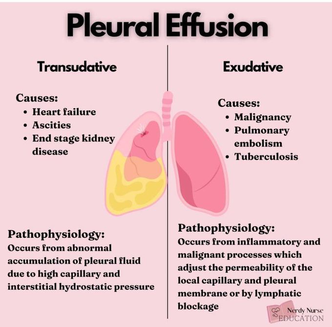 Pleural Effusion