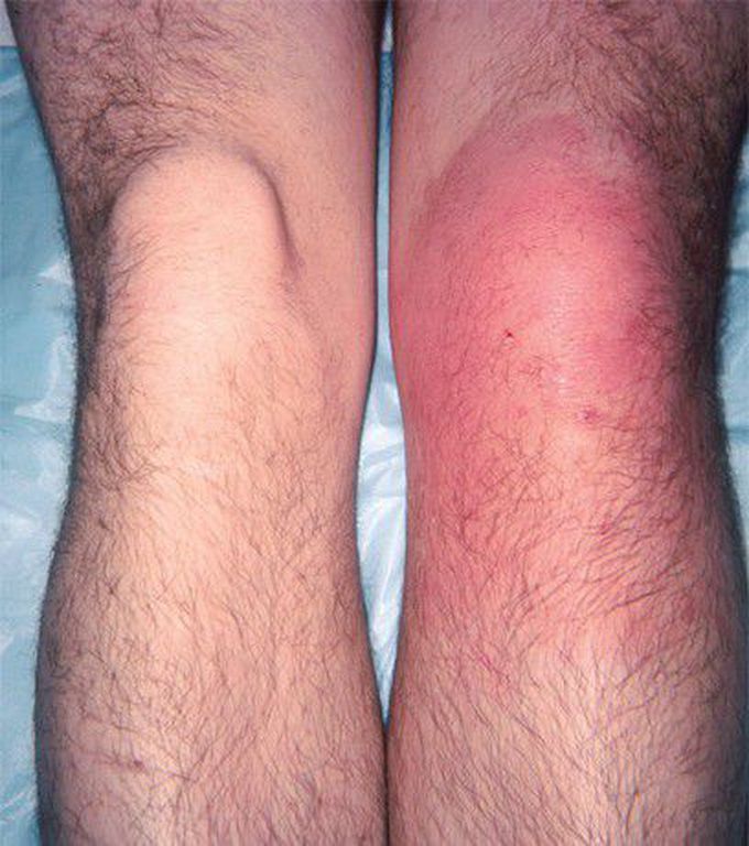 Septic Arthritis