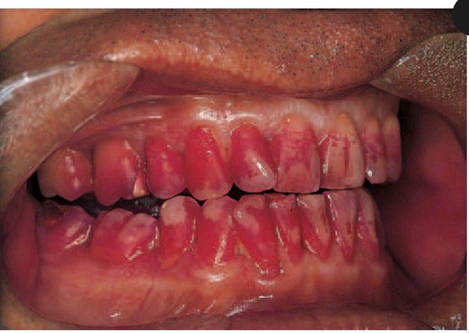 Dental plaque