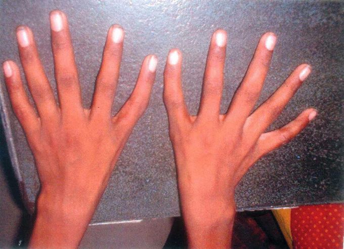 Diamond Blackfan Anemia