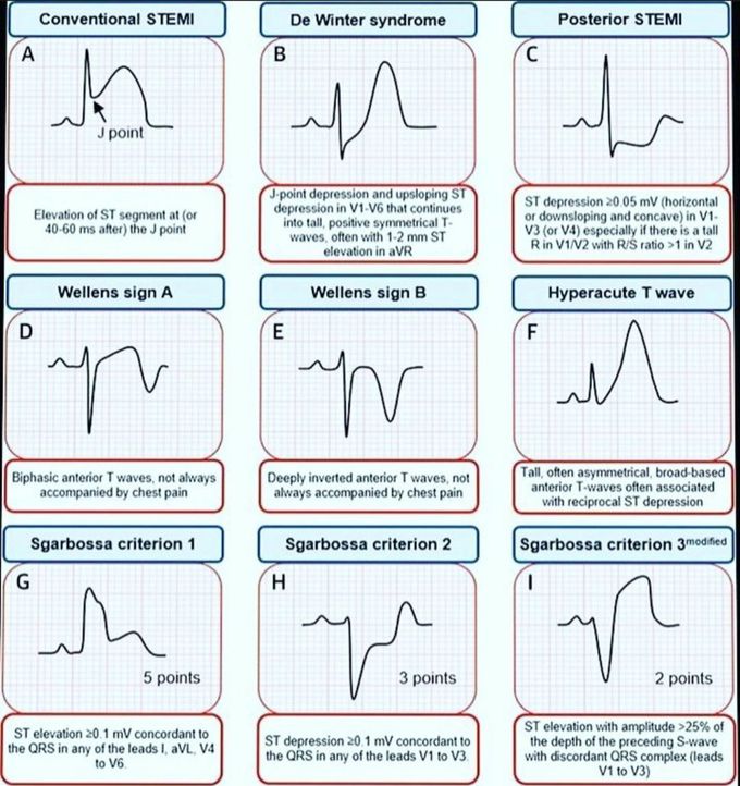 Diagnosis of STEMI equivalent