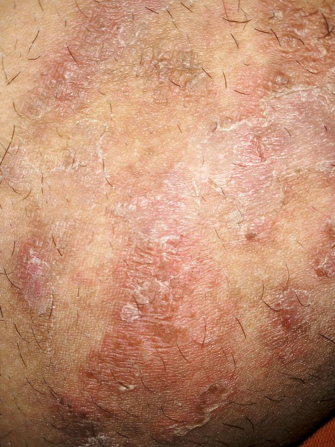 Skin infection