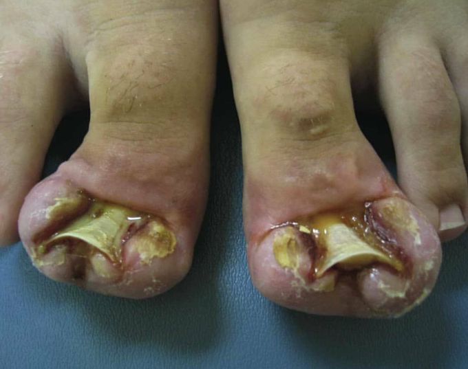An extreme case of bilateral ingrown toenail!