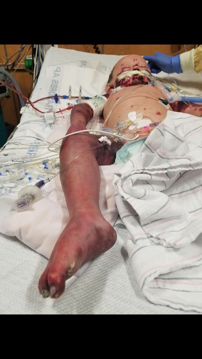 Bacterial/viral infection (undetermined)