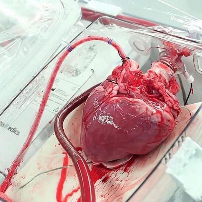 Heart transplantation