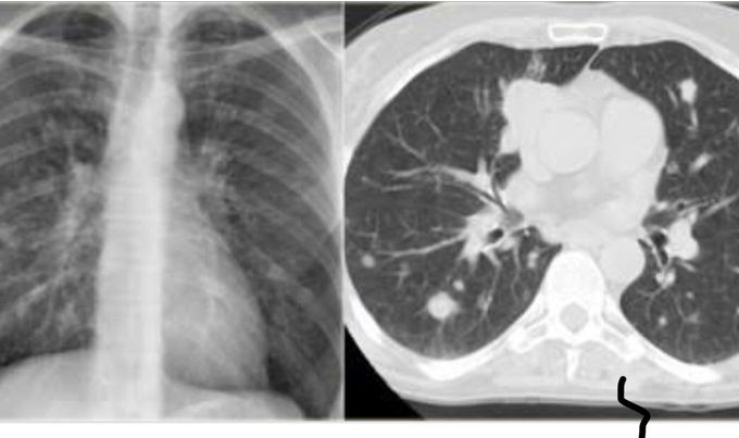 Lung Disease