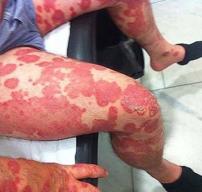 Psoriasis Vulgaris