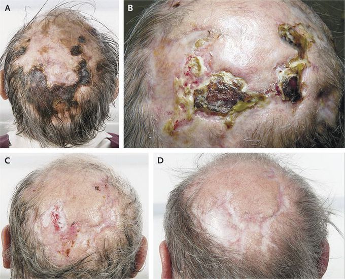 Scalp Necrosis Associated with Giant-Cell Arteritis