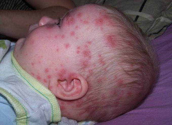 Varicella (chickenpox)