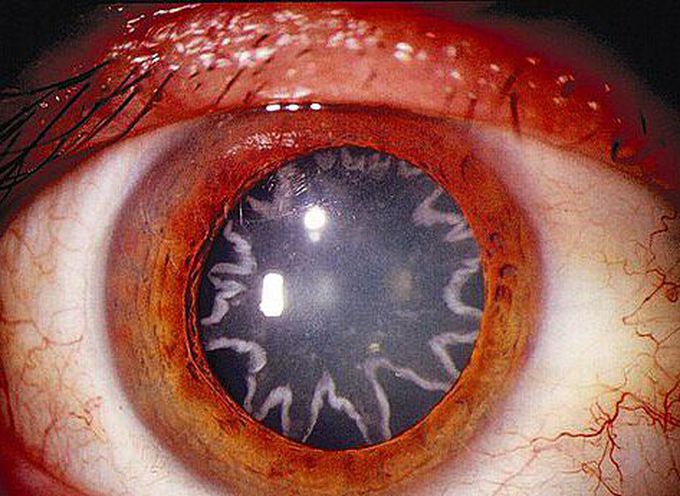 Eye after 14,000-volt shock