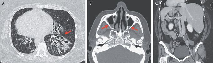 Kartagener’s Syndrome