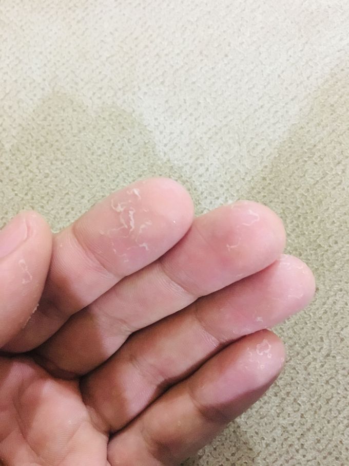 Disease in the derm
