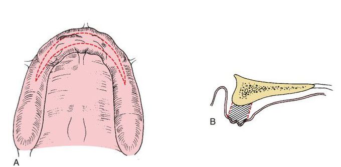 Removal of hypermobile unsupported tissue