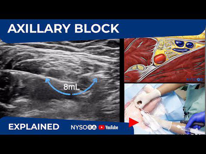 Axillary Nerve Block